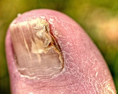 Toenails fungus before laser