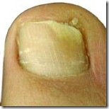 toenail fungus after laser